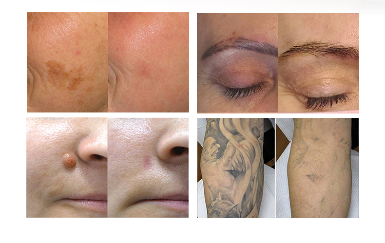 m&aacute;quina l&aacute;ser para eliminaci&oacute;n de tatuajes