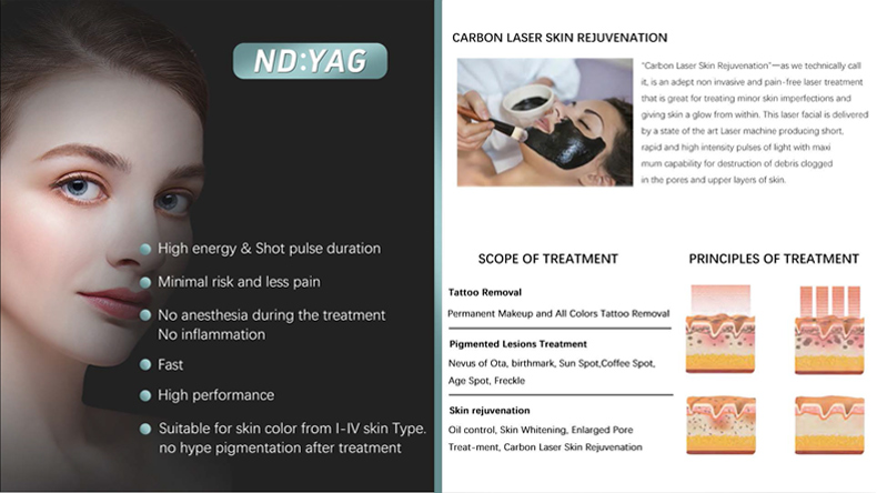 remoci&oacute;n del tatuaje l&aacute;ser